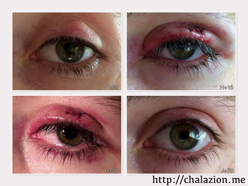 Chalazion Summary